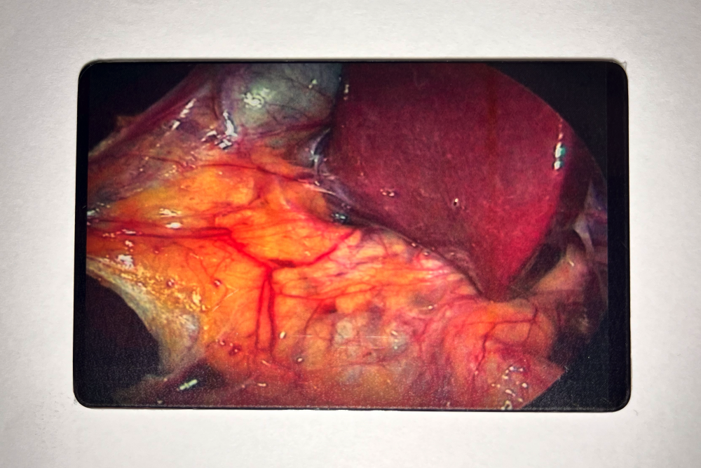 BileDucts Clinical case "Bile Ducts" ICG-Card