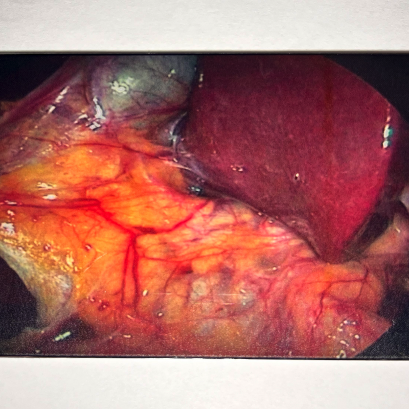 BileDucts Clinical case "Bile Ducts" ICG-Card
