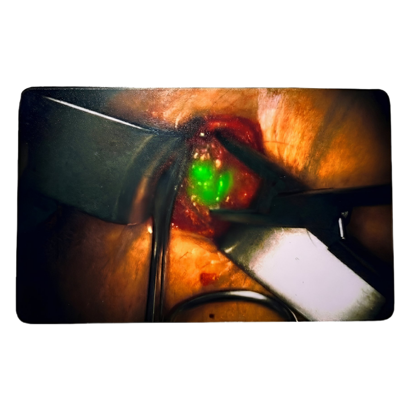Clinical case "Incision" ICG-Card