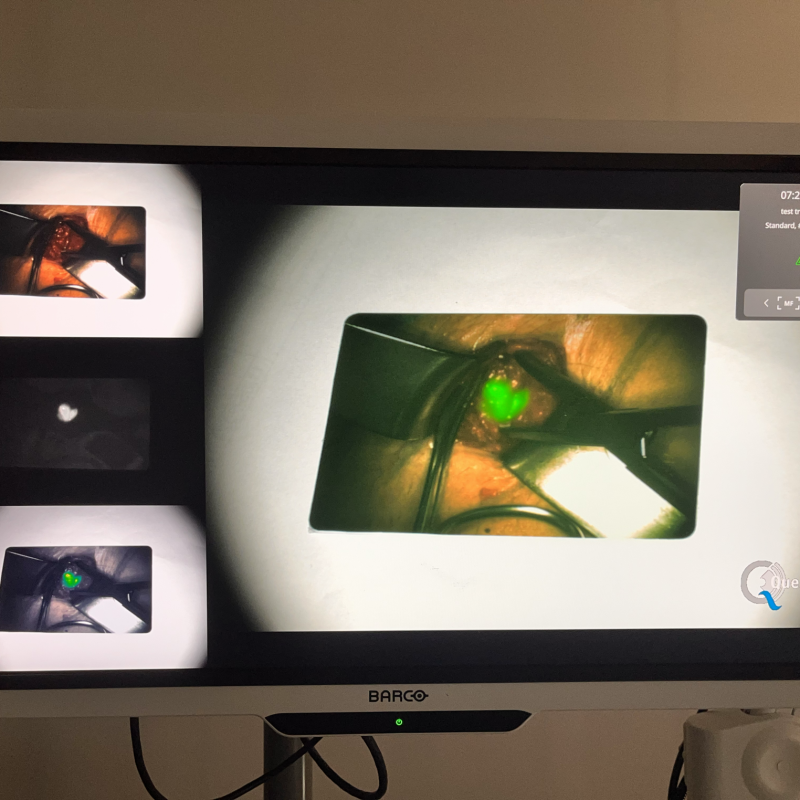 Clinical case "Incision" ICG-Card