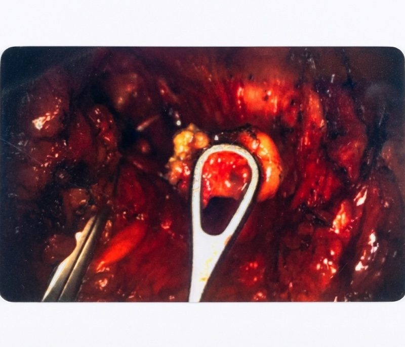 Clinical case "Lymph Node" ICG-Card