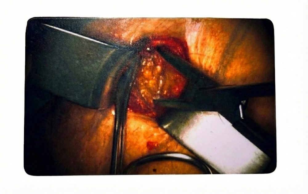 Clinical case "Incision" ICG-Card