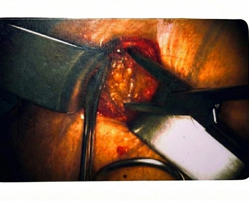 Clinical case "Incision" ICG-Card